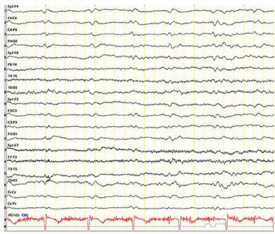 Creutzfeldt-Jakob and Vascular Brain Diseases: Their Overlap and Relationships